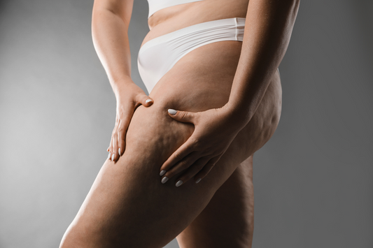 La cellulite. Non è solo un inestetismo estetico!