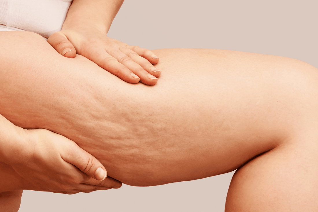 Ridurre la cellulite secondo Andrew D. Huberman
