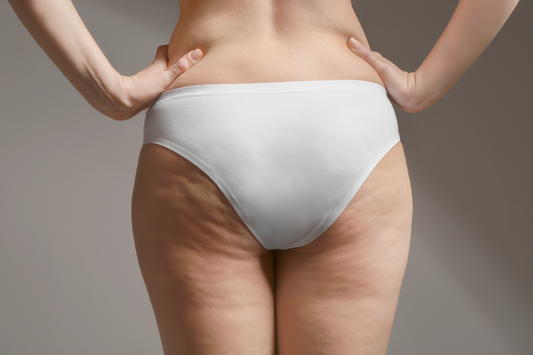 Cellulite alle gambe