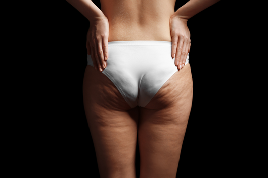 Cellulite sui glutei