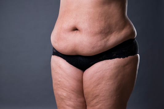 Cellulite sulla pancia